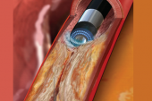 Large UK Study Explores Use of Excimer Laser Coronary Atherectomy 